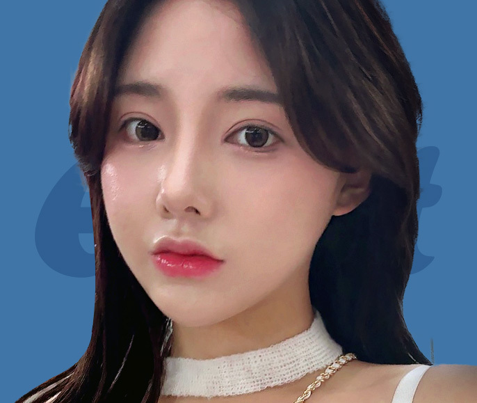 나나 얼굴지방이식♥