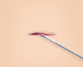 4mm 최소절개, 흉터걱정 NO