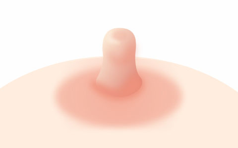 비정상적인 유두