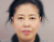 눈 before after