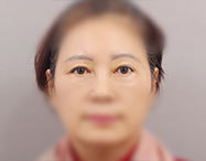 눈 before after