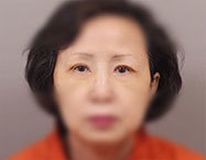 눈 before after
