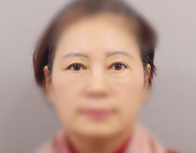 눈 after 이미지