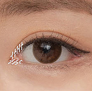 섬세한 봉합