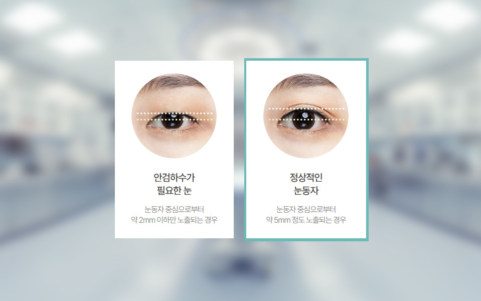 나나성형외과의 절개 눈매교정