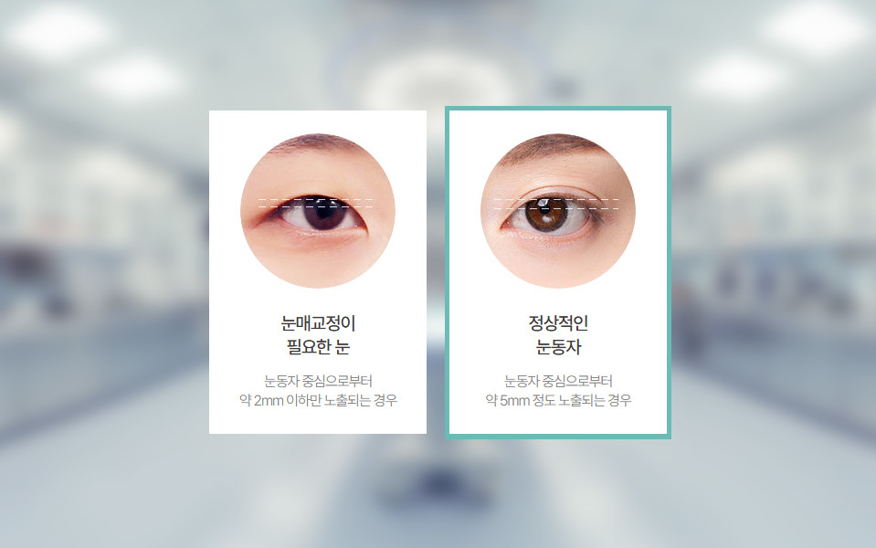 나나성형외과의 비절개 눈매교정