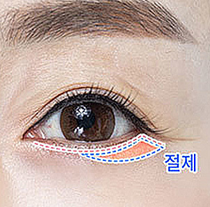 리프팅 시행 후 남는 피부 절제