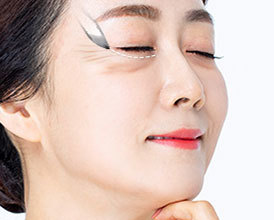 눈 아래 절개창을 만들어줍니다