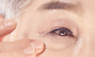 눈 밑 지방이 볼록하면서 깊은 주름이 생긴경우