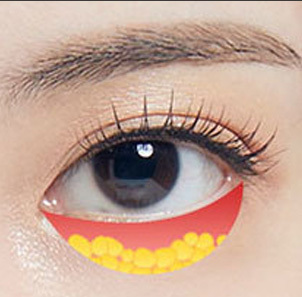 눈밑지방재배치