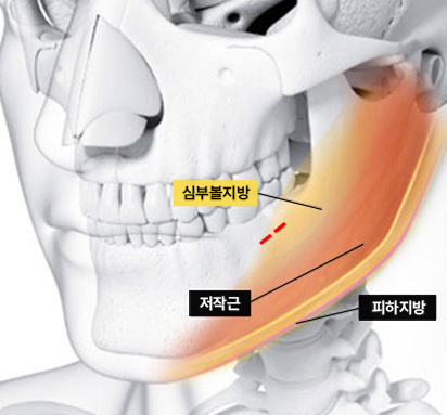심부볼 지방제거