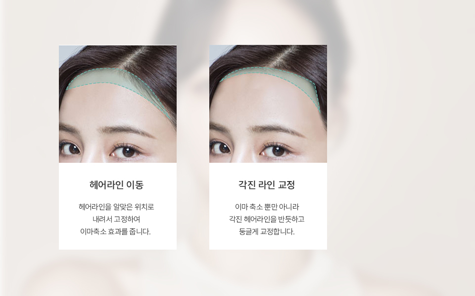 나나성형외과 이마축소술 과정 이미지, 헤어라인 이동과 각진 라인 교정을 통해 이마 옆라인을 자연스럽게 개선한 예시 이미지