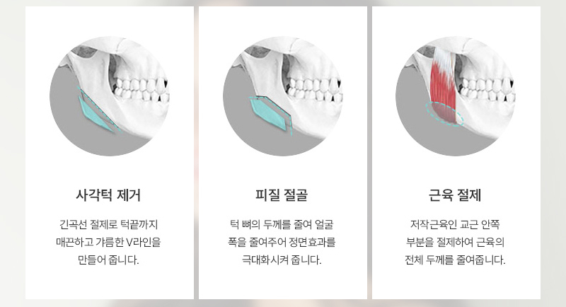 개인 얼굴형에 맞춘 사각턱 재수술 방법 안내