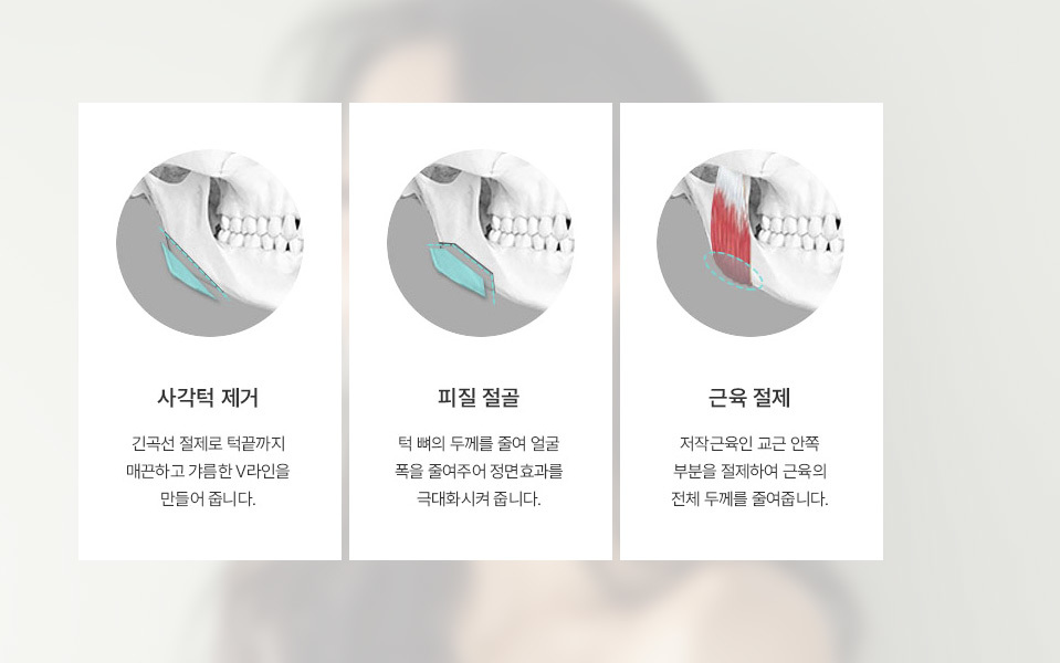 나나성형외과 사각턱 재수술 설명 문구, 개인 얼굴형에 맞춘 사각턱 재수술 방법 안내