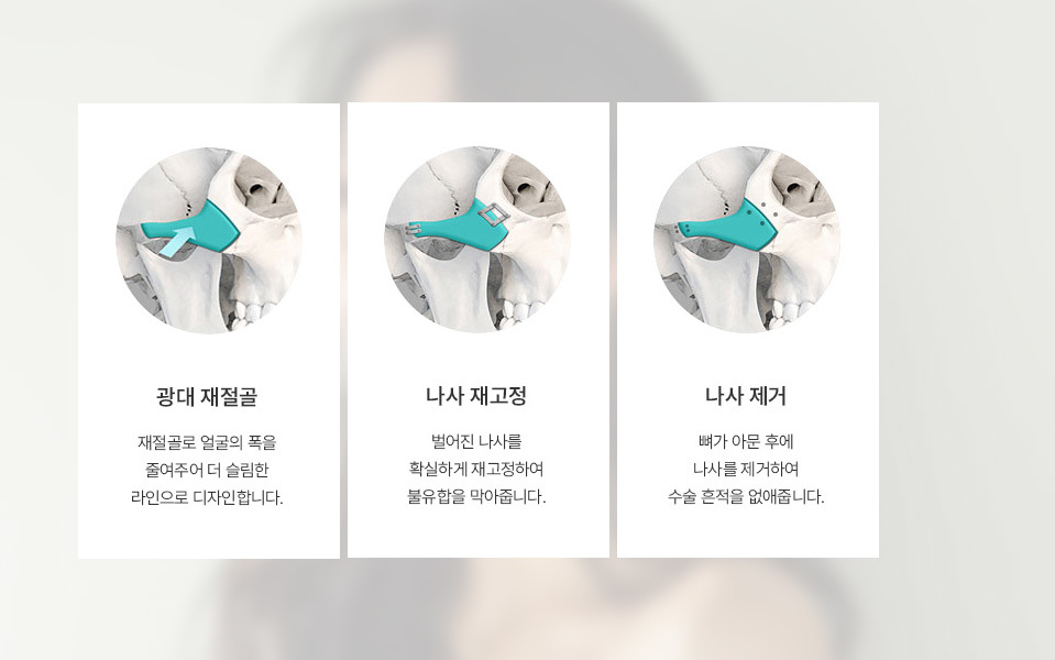 나나성형외과 광대 재수술 설명 문구, 개인 얼굴 구조에 맞춘 광대 재수술 방법 안내