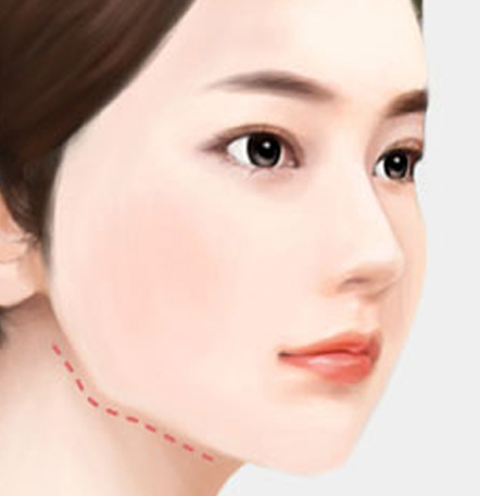 나나성형외과 안면윤곽 재수술 필요 사례 이미지, 1차 윤곽수술 후 이차각이 생긴 경우