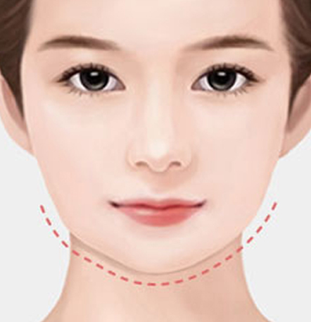 나나성형외과 안면윤곽 재수술 필요 사례 이미지, 1차 윤곽수술 후 안면 비대칭이 생긴 경우