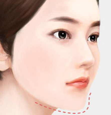 나나성형외과 안면윤곽 재수술 필요 사례 이미지, 1차 윤곽수술 후 부정유합이 발생한 경우