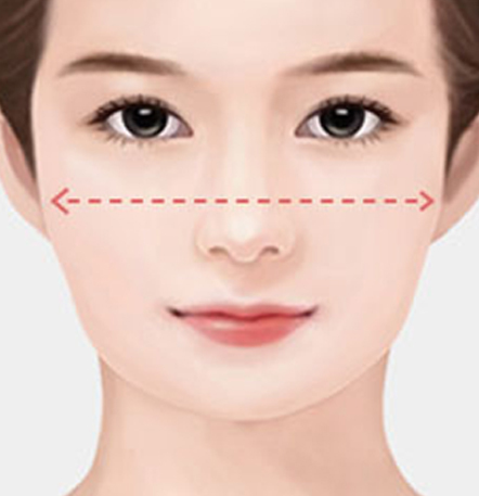 나나성형외과 안면윤곽 재수술 필요 사례 이미지, 1차 윤곽수술 후 얼굴 폭 감소가 충분하지 않아 재수술을 고려하는 경우