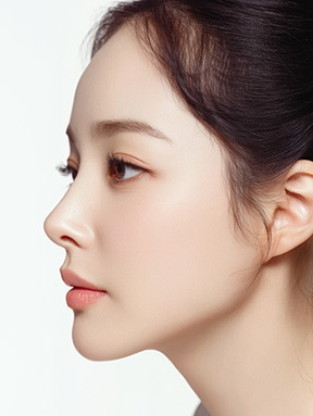 나나성형외과 윤곽 재수술 결과 이미지, 어느 각도에서도 슬림하고 균형 잡힌 얼굴 라인이 표현된 측면 모습