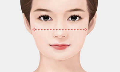 얼굴의 폭이 줄어들지 않은 경우