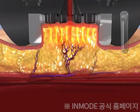 이중턱, 처진 볼, 잔주름 개선