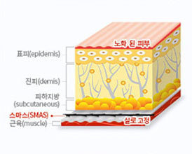 실을 삽입