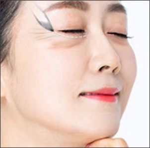 작은 절개창 생성