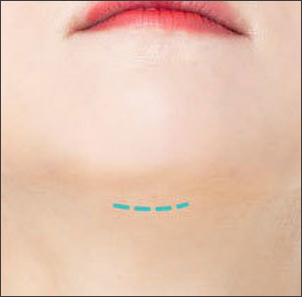 턱 밑 절개 주변 지방 정리