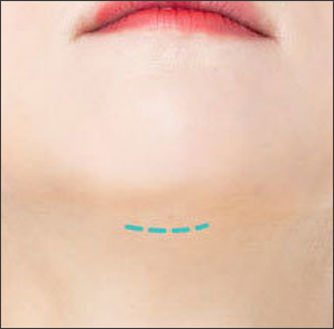 턱 선과 목선을 함께 개선