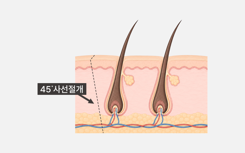나나성형외과 포니테일 리프팅의 헤어라인 안쪽 히든 절개 방법