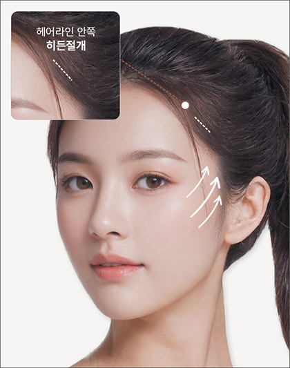 모델의 헤어라인 안쪽 히든절개로 진행되는 포니테일 리프팅 영역 표시