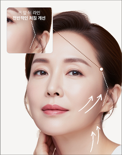 모델의 귀 앞 뒤 라인의 전반적인 처짐 개선인 안면거상술 영역 표시