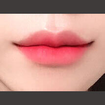피부과 before이미지