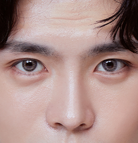 이마에 주름이 심한 경우