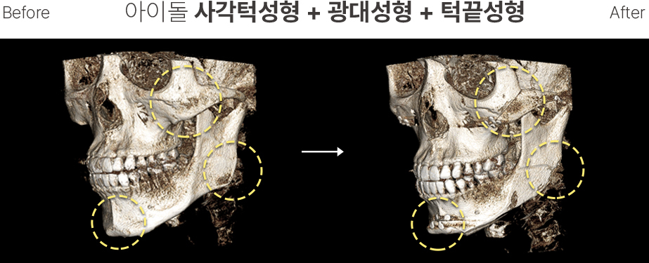 남자윤곽 CT2