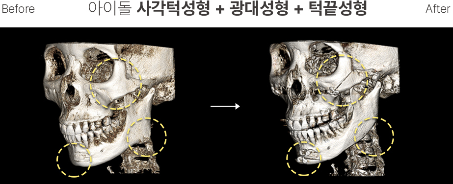 남자윤곽 CT4
