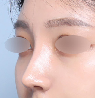 맞춤형 코성형을 진행한 낮은 코 유형 고객의 수술 후 45도 부분 이미지