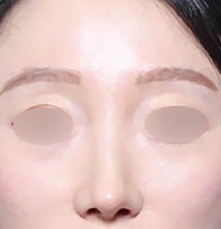 맞춤형 코성형을 진행한 휜코 유형 고객의 수술 후 정면 부분 이미지