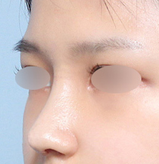 맞춤형 코성형을 진행한 복코 유형 고객의 수술 후 45도 부분 이미지
