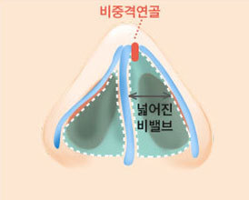 비밸브 협착증