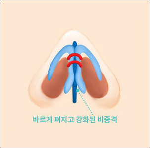 비중격과 코 내부 강화