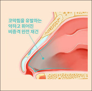 비중격 완전 재건술