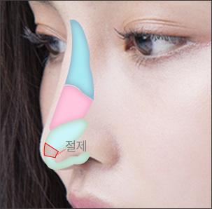 코끝 연골 절제