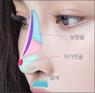 보형물을 이용해 콧대를 높임
