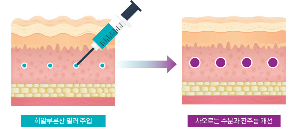 시술원리