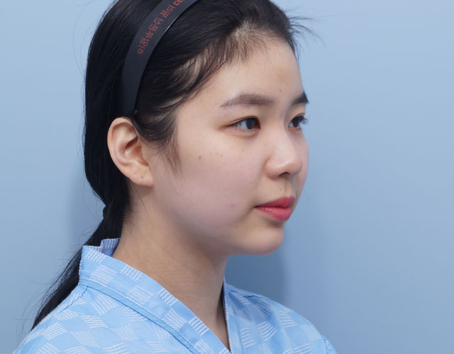 눈 before이미지