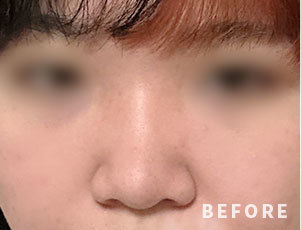 성형 전 이미지