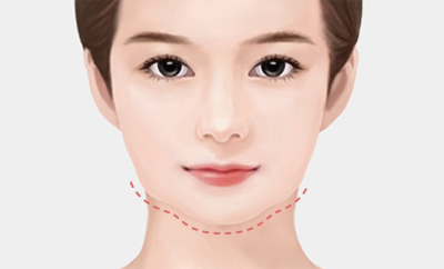 턱선이 울퉁불퉁해진 경우