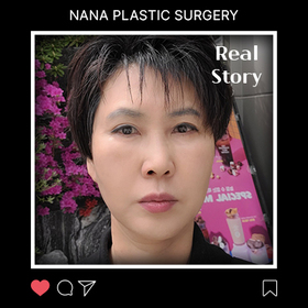 안면거상 후기